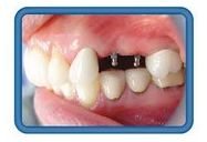 mini implants